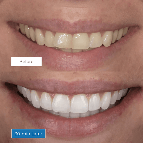 GetWhite Teeth Whitening Strips